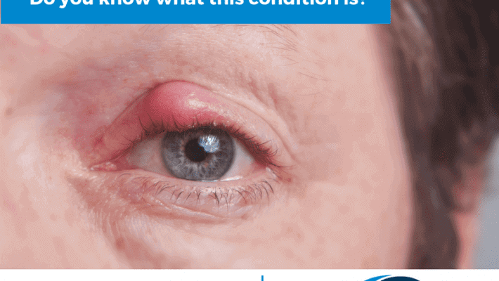 What is a Chalazion and How Do I Treat It? | Specialty Eye Institute